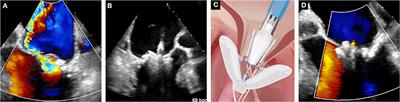 Mitral and Tricuspid Transcatheter Interventions Current Indications and Future Directions